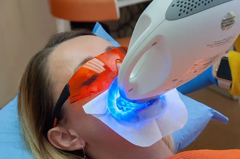 Bleaching-Behandlung in der Access Smile Zahnklinik