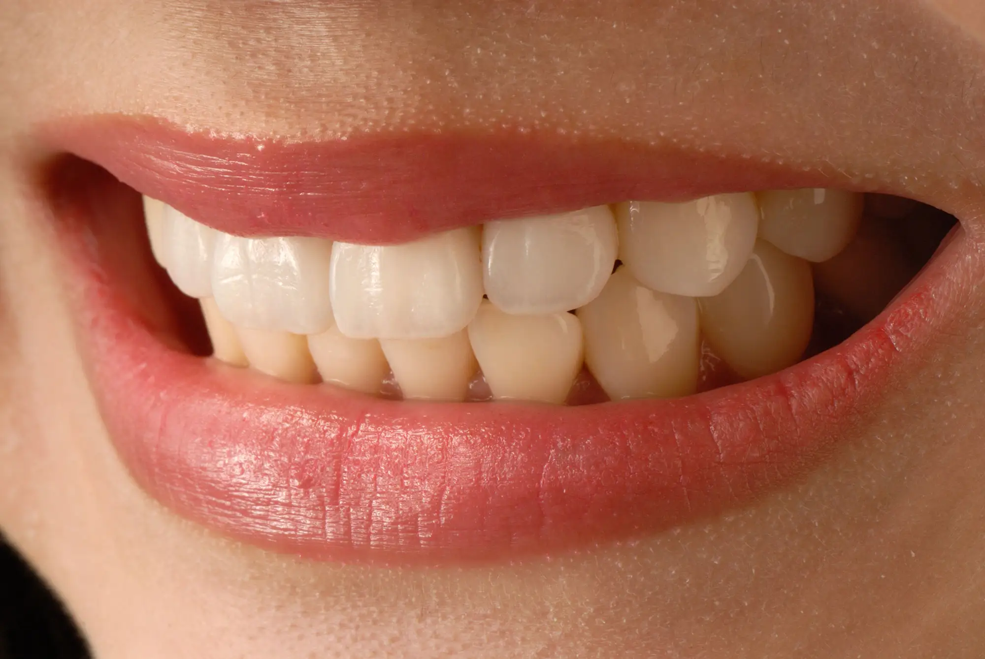 Herstellung eines Veneers